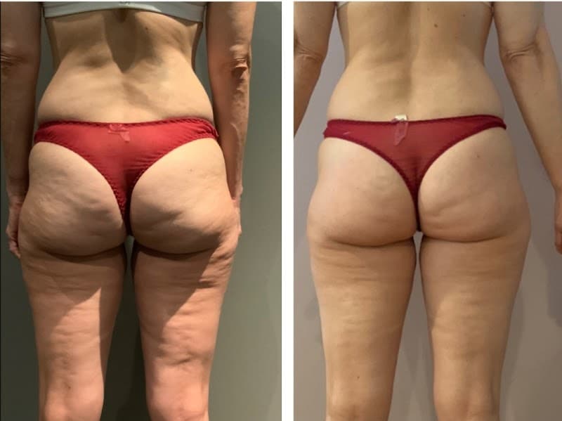 Lotus Body Sculpting Winsted photo