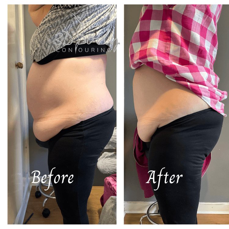 Tunbridge Wells 3D-BodyContouring photo