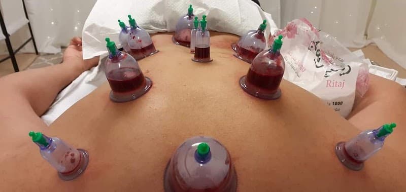 Alafia för Hijama Linköping photo