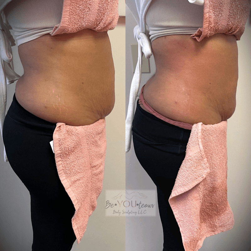 BeYouteous Body Sculpting Toledo photo