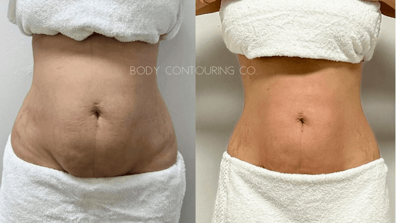 Body Contouring Miami Doral photo
