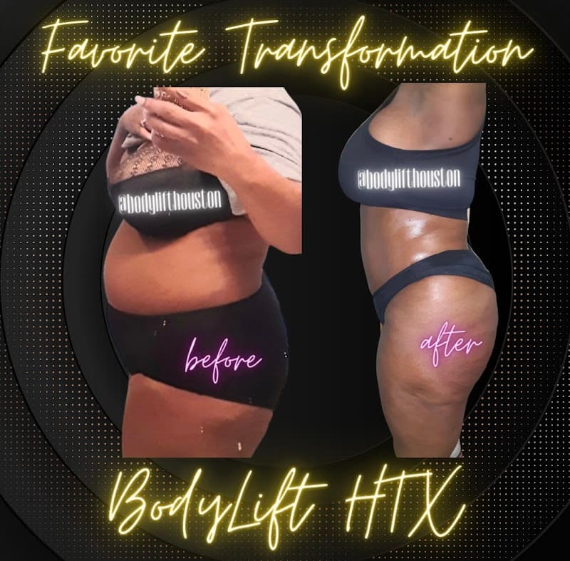 BodyLift Htx Houston photo
