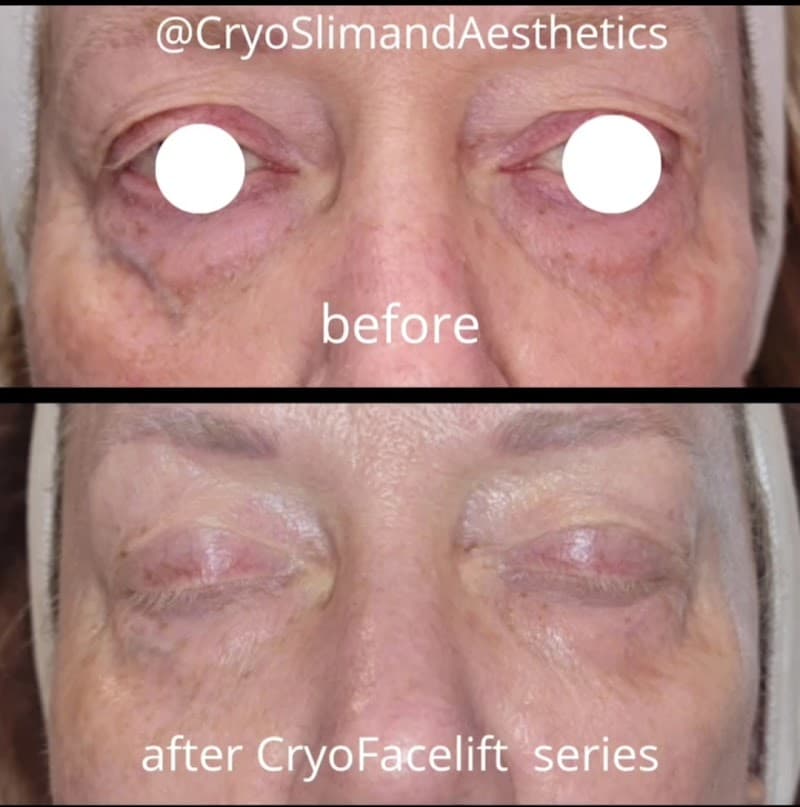CryoSlim & Aesthetics by Pam Walker St Johns photo