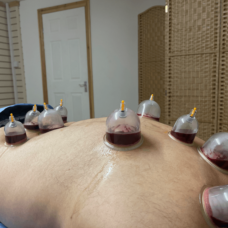 Hijama Cupping Therapies Bradford photo