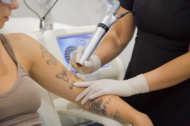 Laser Tattoo Removal Clinic Perth photo