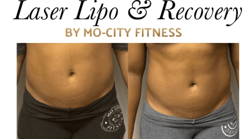 Lipo Laser & Recovery Stafford photo