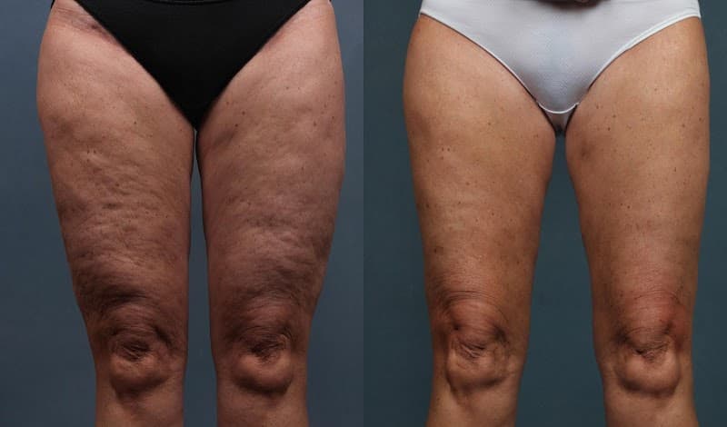 Luminized Body Sculpting & Wellness Cincinnati photo