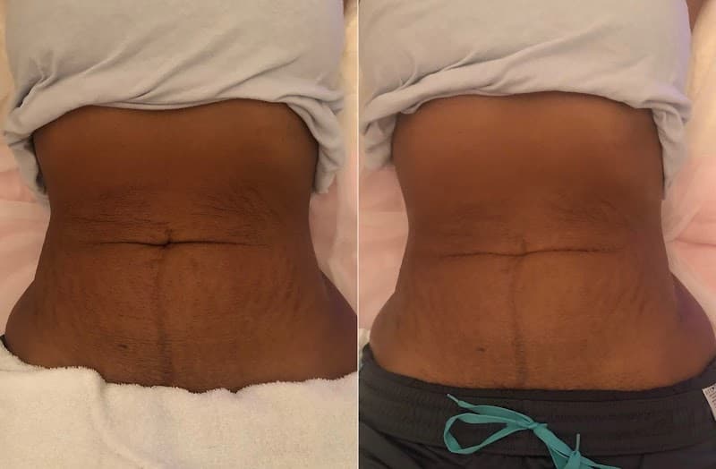 New Image Body and Face Contouring Wellington photo