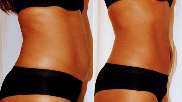 Phenomenal Curves Body Contouring, LLC Columbus photo