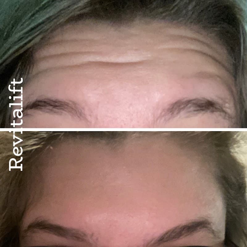 Revitalift Aesthetic Center Lincoln photo