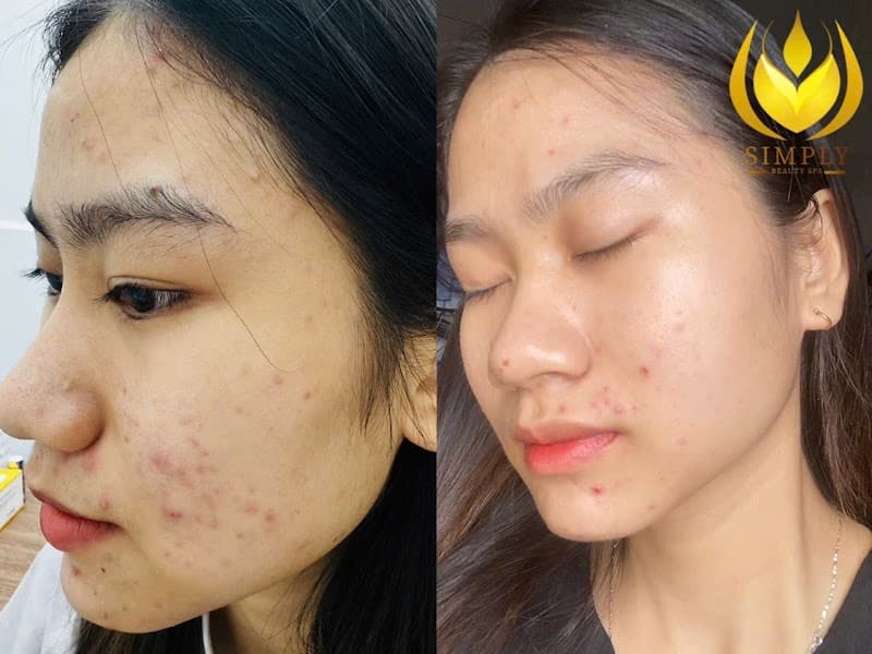 Simplybeauty Spa-Spa uy tín Gò Vấp-Chăm sóc Da-Thư giãn Cổ Vai Gáy -Gội đầu Detox-Lấy nhân mụn bằng tay Quận Gò Vấp photo