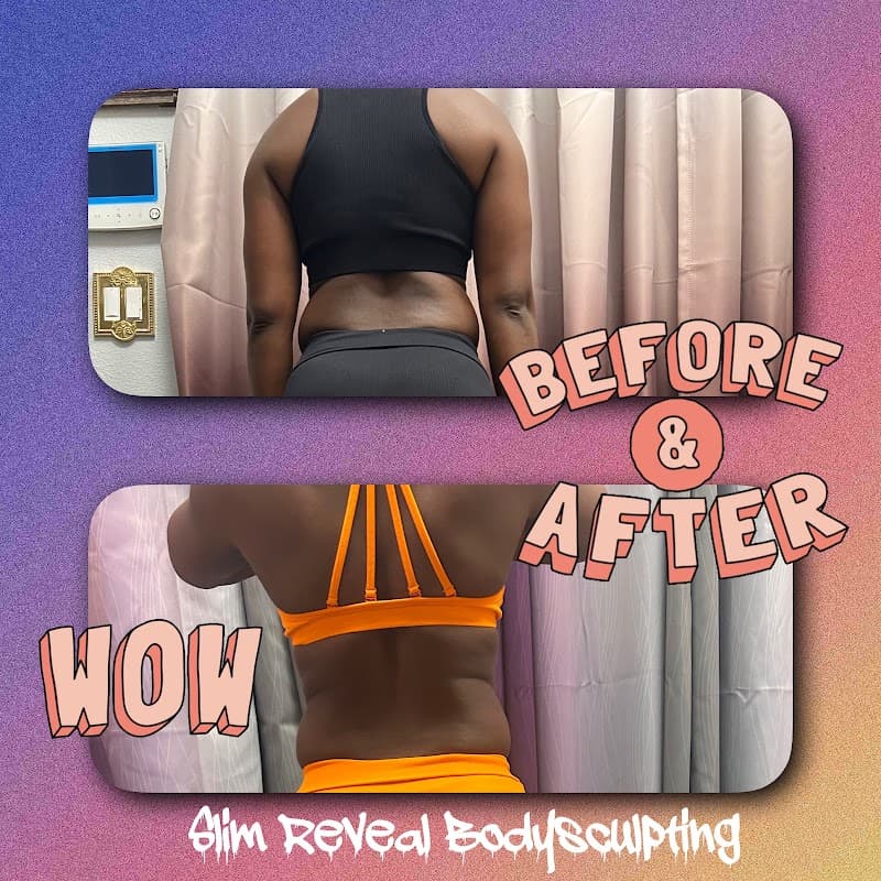 Slim Reveal Bodysculpting San Jose photo