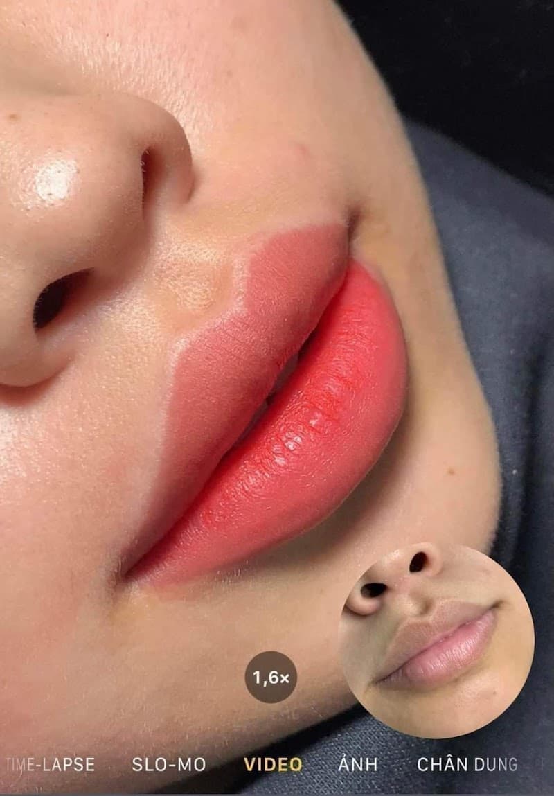 Thẩm Mỹ Quỳnh Anh Đặc Trị Nám Huyện Thường Tín photo