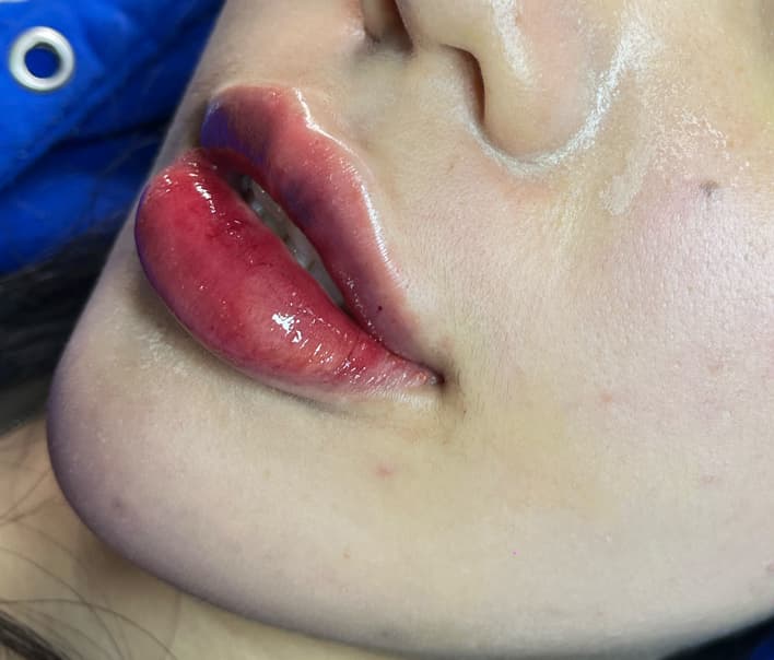 TiÊM Filler QuẬN 5 | TiÊM Filler Botox QuẬN 5 | ThẨM MỸ QuẬN 5 Quận 5 photo