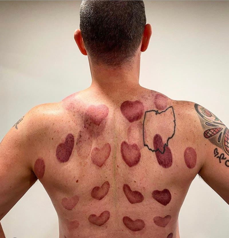 Ventouse Therapie Longueuil photo