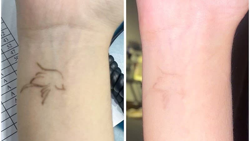 Xoá xăm Bình Chánh - Bí Beauty Huyện Bình Chánh photo